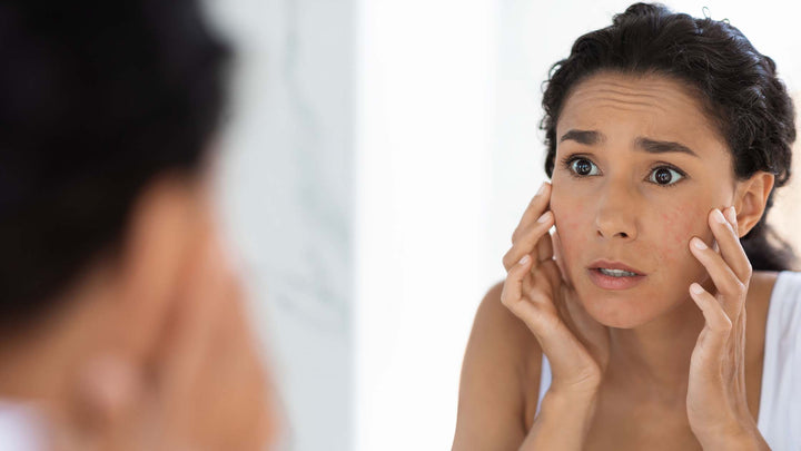 Effective Ways of Preventing and Treating Acne Breakouts